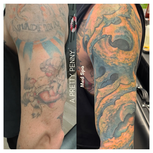 Tattoo removal w/ cover-up