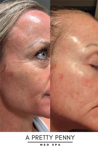 Skin Resurfacing