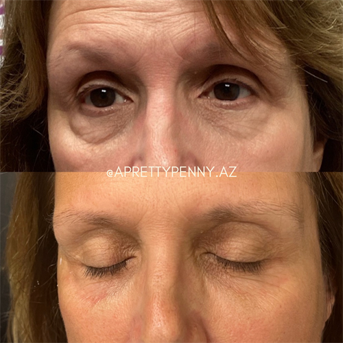PRP undereyes