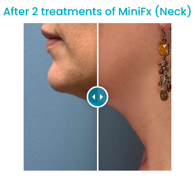 After 2 treatments of MiniFx (Neck)