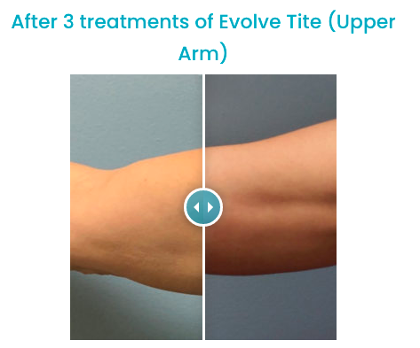 After 3 treatments of Evolve Tite (Upper Arm)