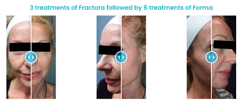 3 treatments of Fractora followed by 6 treatments of Forma