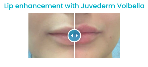 Lip enhancement with Juvederm Volbella