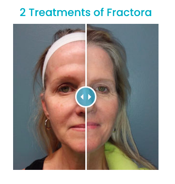 2 Treatments of Fractora