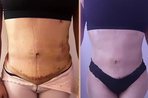Post-Op Care for liposuction W/tummy tuck