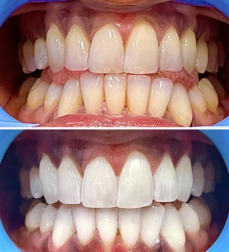 Instant results 90 min session-We target the gum line and every tooth evenly.