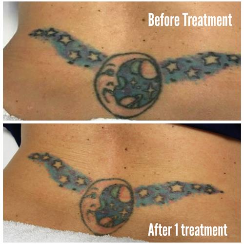 Tattoo removal after 1 treatment