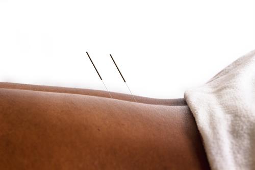 Image close up of a black persons with acupuncture needles on their back. 