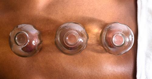 Image horizontal frame and close up of a black person with glass cups on their back. 
