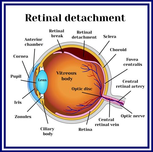 Retinal Detachments are an urgent matter that requires Immedient medical attention to help preserve your vision. 