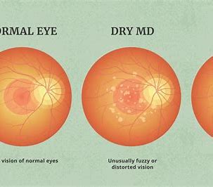 Macular Degeneration is one of the most common retinal diseases that can arise with aging.