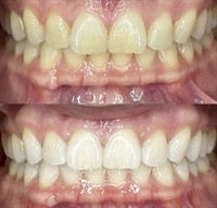 Alpenglow Teeth Whitening  - Stateline