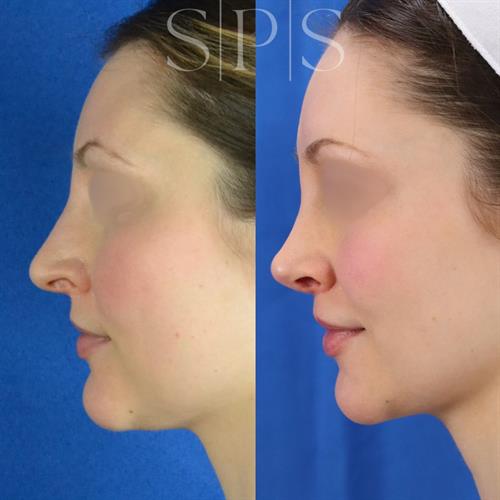 Before and After rhinoplasty 