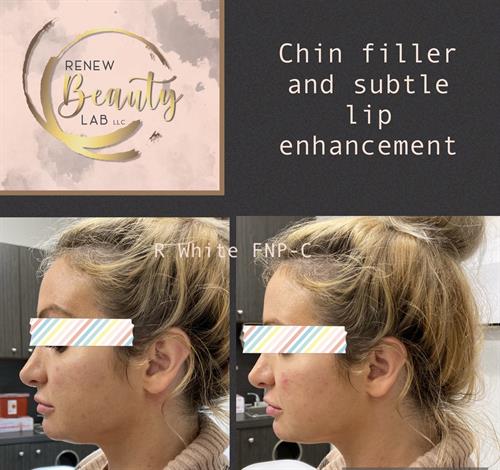 Gallery Image cheekfill.jpg