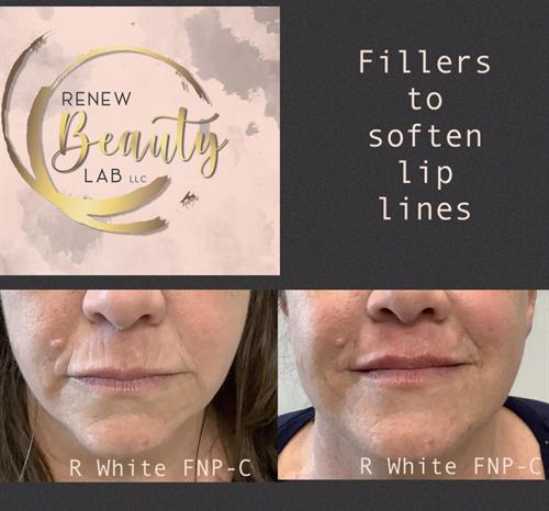 Gallery Image lipfill.jpg