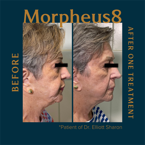 This Morpheus8 patient experienced reduced skin sagging, reduction in wrinkles and reduction in pore size after only one treatment.