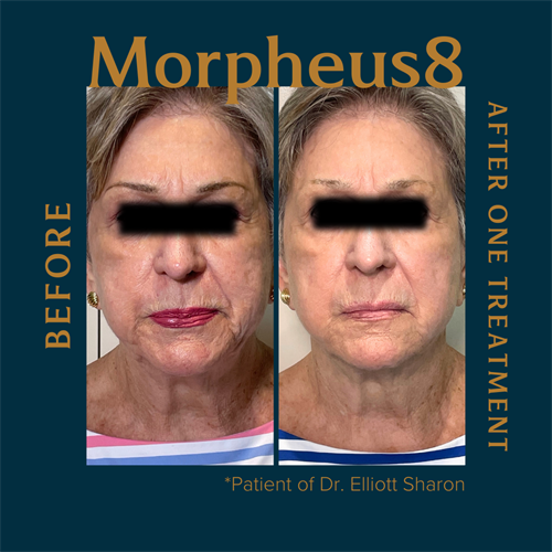 InMode's Morpheus8 is one of the aesthetic treatments Dr. Sharon offers. Radio frequency microneedling can be performed anywhere on the face and body and on all skin types and tones!
