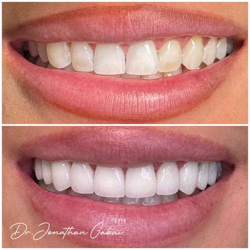 Before and After Veneers