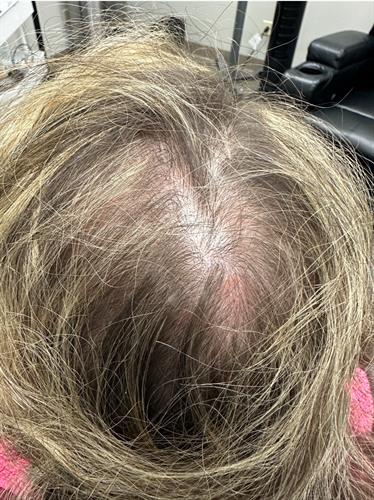 Hair pattern in 43 year old female before platelet rich plasma and exosome therapy