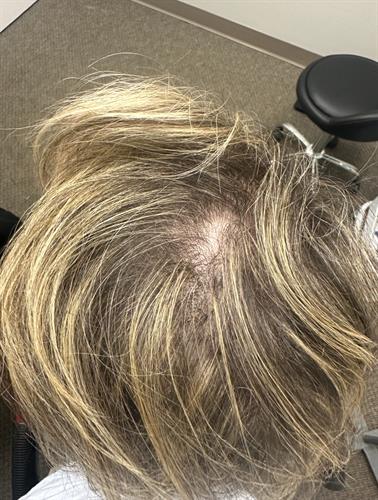 Hair pattern in 43 year old female 2 months after one platelet rich plasma and exosome therapy session