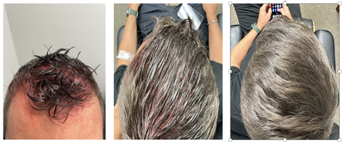 Hair growth after use of platelet rich plasma and exosome therapy over 12 weeks.