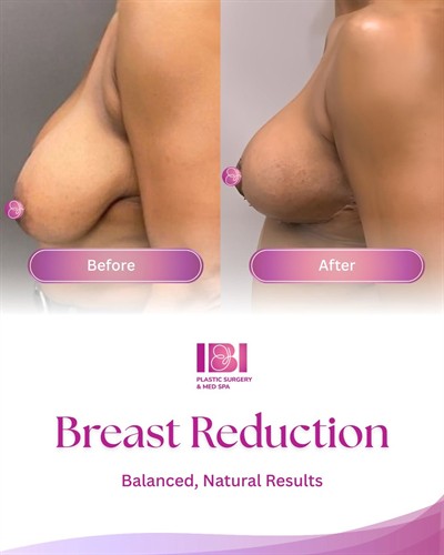 Breast Reduction + Breast Lift (Mastopexy) ??  Same patient, two goals: feel lighter and achieve a more balanced, natural silhouette.  Breast reduction is designed to decrease volume and improve body proportion for enhanced comfort. A breast lift focuses on reshaping and elevating the tissue for a more youthful, lifted position.  When combined, these procedures provide a complete transformation of both size and contour?