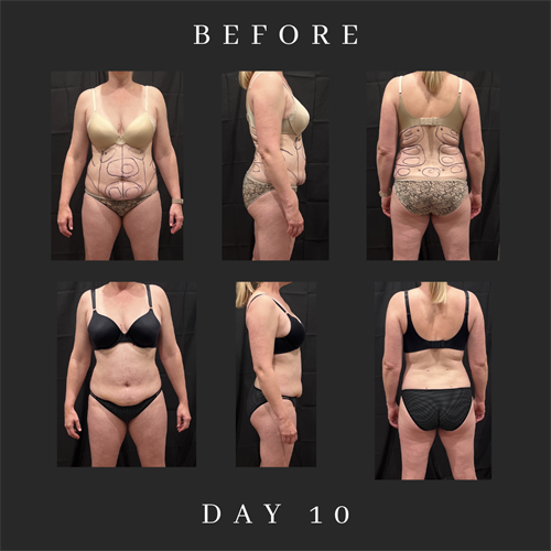 Before after picture lipo360