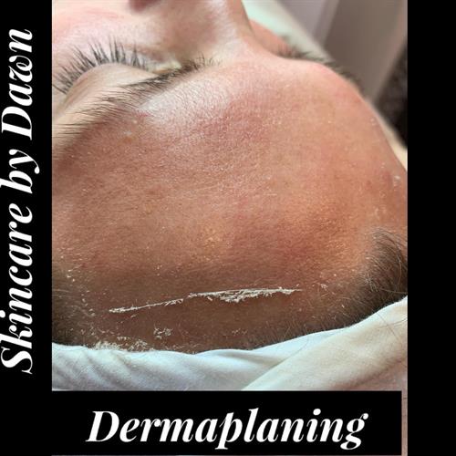 Dermaplaning