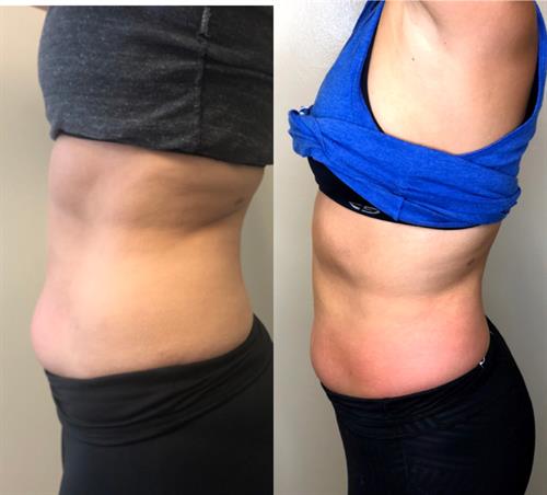 Cryo Slimming Permanent Fat Reduction