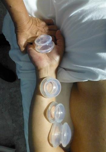 Neuromuscular Cupping 