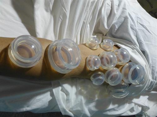 Neuromuscular Cupping 