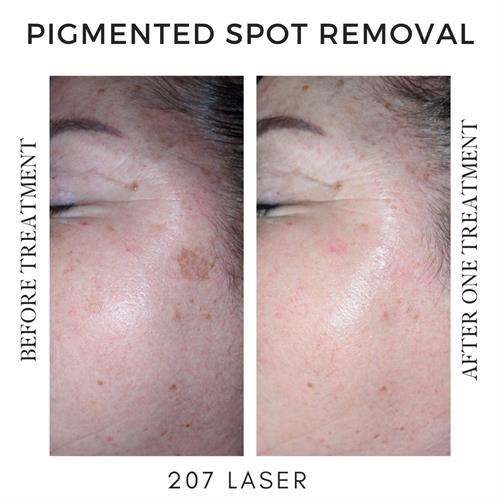 Pigmented Spot Removal Via Laser 