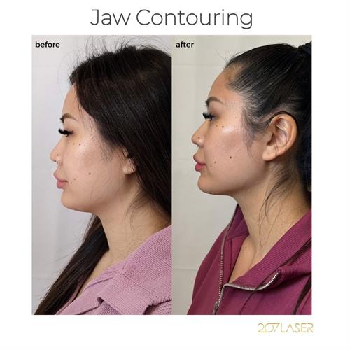 Jaw Contouring via Dermal Fillers.