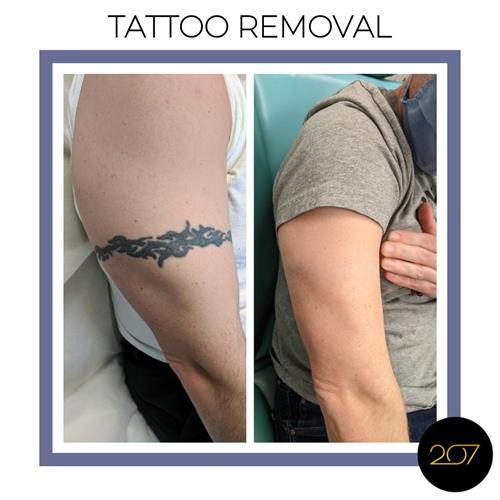 We Specialize in Laser Tattoo Removal.