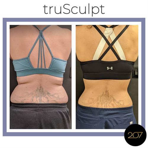 truSculpt iD : Body Contouring 