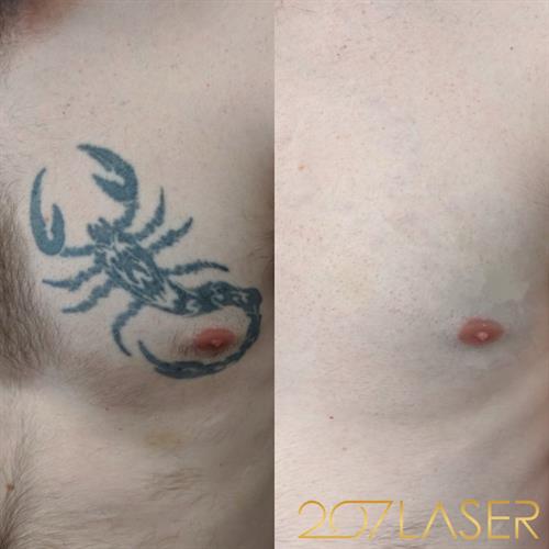 Laser Tattoo Removal via PicoSure Technology.