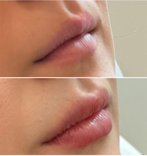 Before  & After Lip filler