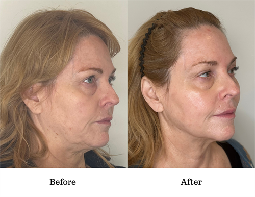 Before & After Sculptra