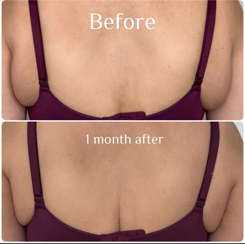 Before  & After  Bra Fat Removal