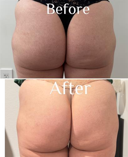 Before & After  Non-Surgical Butt Fat Removal