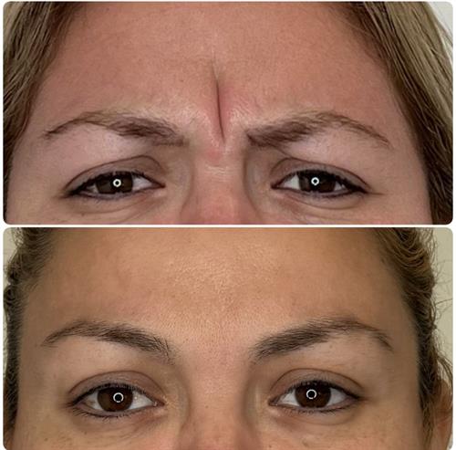 Before & After  No to any deep frown line