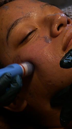 Hydrodermabrasion