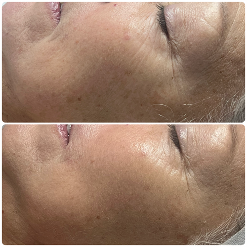 Before and after Custom facial, at A. Beauty in Gahanna, Ohio
