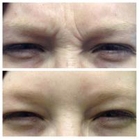 Dysport/Botox For Expression Lines