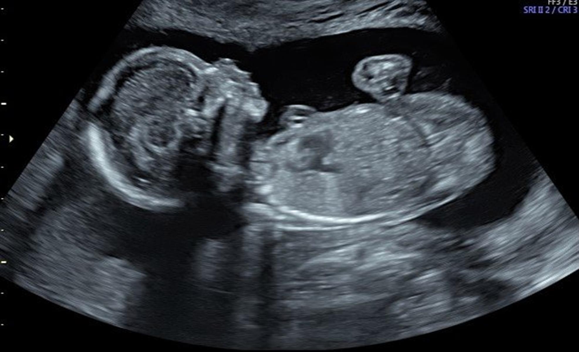 Precious Baby Peek Ultrasound - 2D/3D/4D/HD Live Ultrasound Services