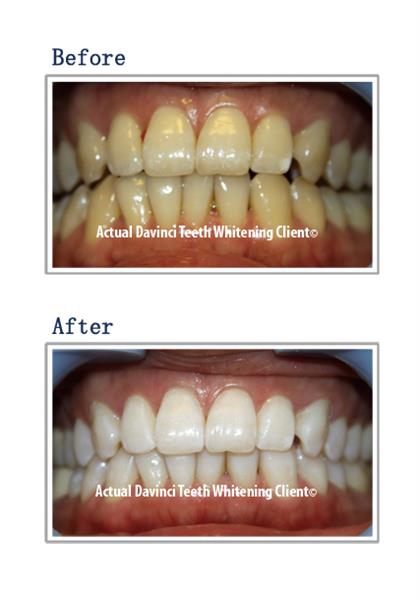 Results of Before and After a DaVinci Teeth Whitening. 