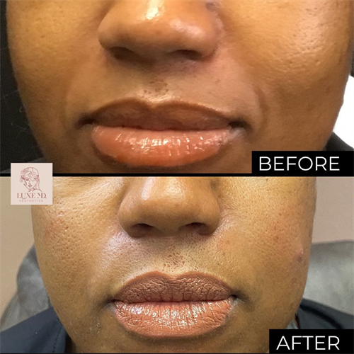 Soften nasolabial folds by adding lost volume to the cheeks