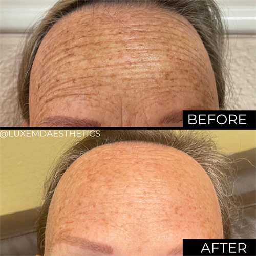 Soften forehead lines while still maintaining movement & a natural look.