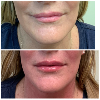 Refresh Your Look This Summer with Facial Harmonization at AloEver Medspa
