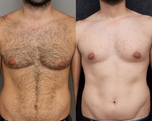 Gallery Image chest_hair_removal.jpg
